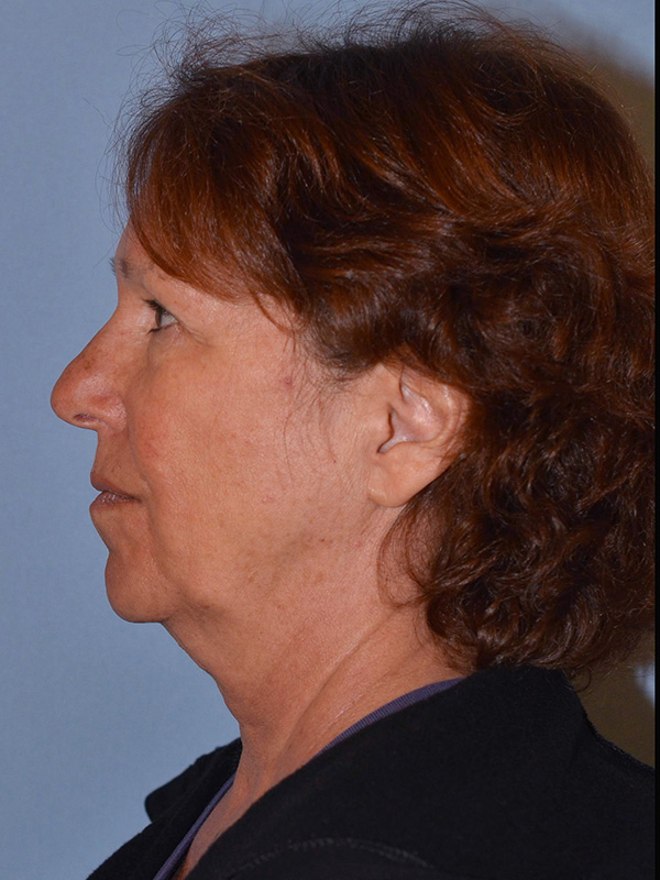 Facelift: Lower Face And Neck Lift Before and After 12