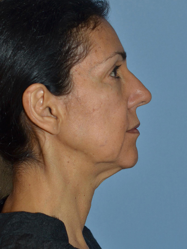 Lower Face And Necklifts Before and After 13