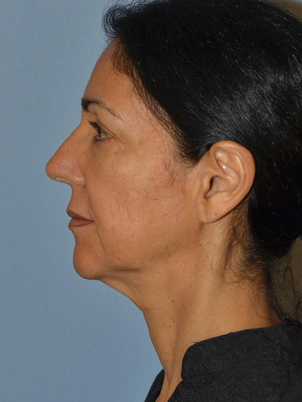 Facelift: Lower Face And Neck Lift Before and After 13