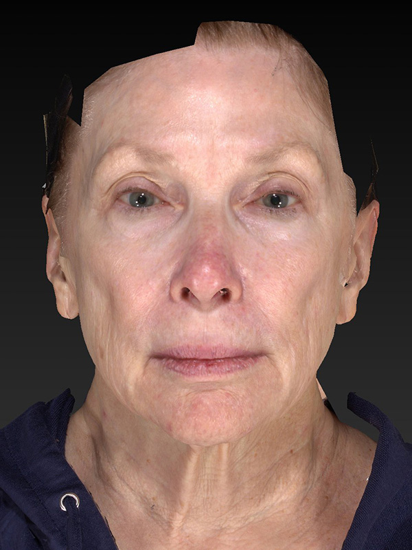 Facelift: Lower Face And Neck Lift Before and After 14