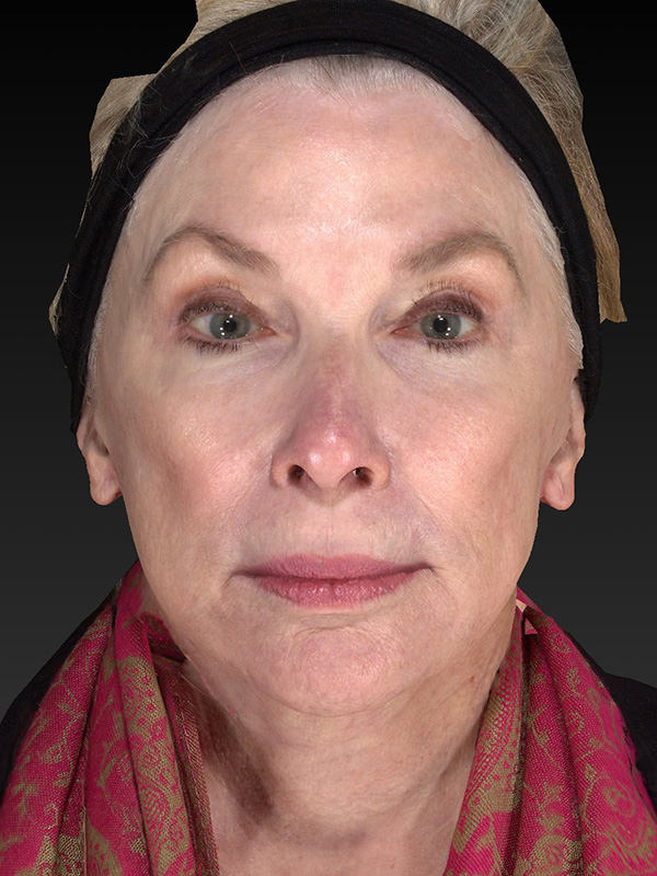 Facelift: Lower Face And Neck Lift Before and After 12