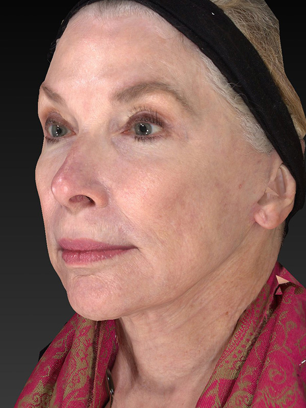 Facelift: Lower Face And Neck Lift Before and After 14