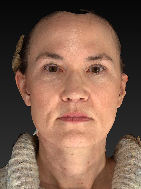 Facelift: Lower Face And Neck Lift Before and After 07