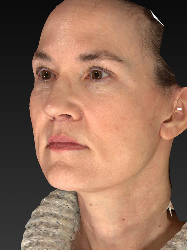 Facelift: Lower Face And Neck Lift Before and After 15