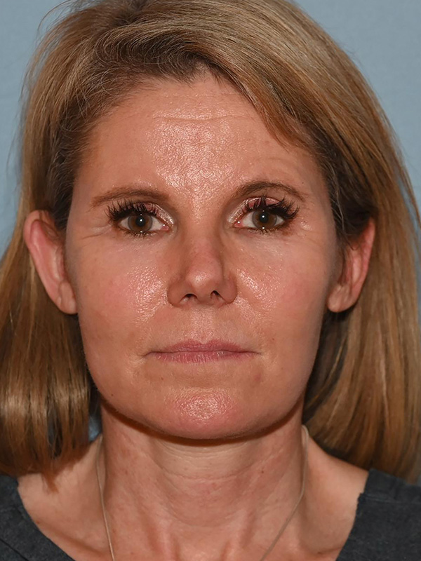 Facelift: Lower Face And Neck Lift Before and After 08