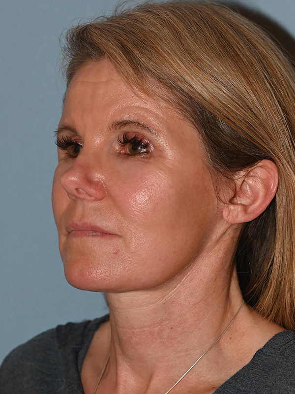Facelift: Lower Face And Neck Lift Before and After 16
