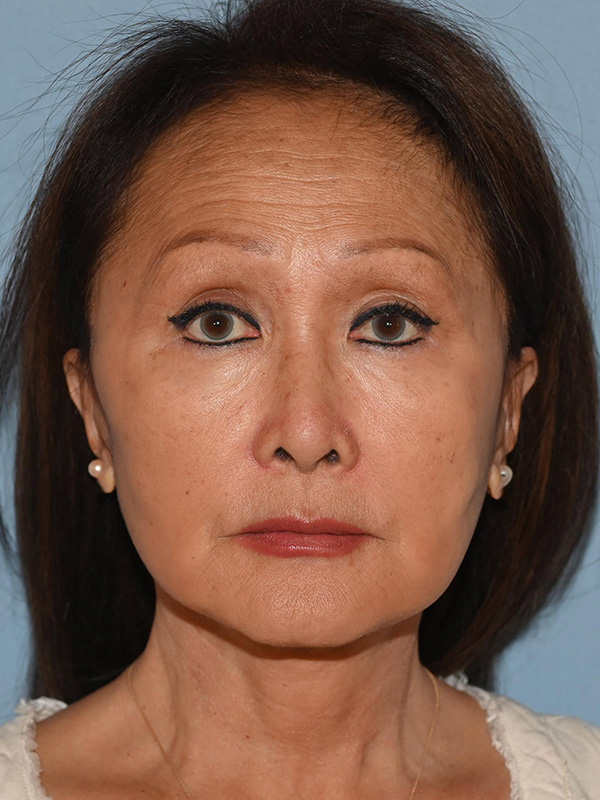 Facelift: Lower Face And Neck Lift Before and After 29