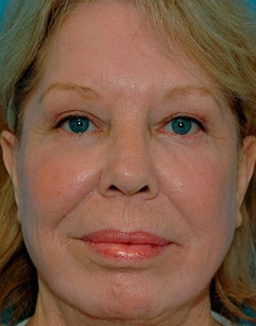 Facelift: Lower Face And Neck Lift Before and After 01