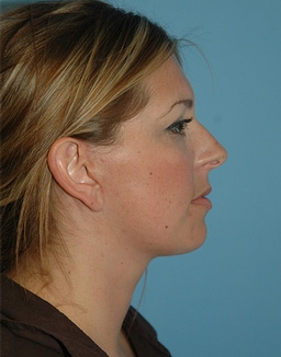 Facelift: Lower Face And Neck Lift Before and After 05