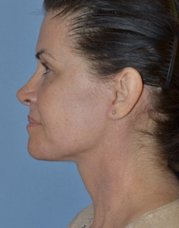Facelift: Lower Face And Neck Lift Before and After 21