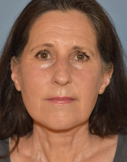 Facelift: Lower Face And Neck Lift Before and After 09