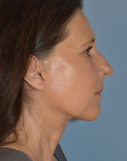 Facelift: Lower Face And Neck Lift Before and After 23