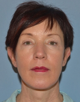 Facelift: Lower Face And Neck Lift Before and After 03