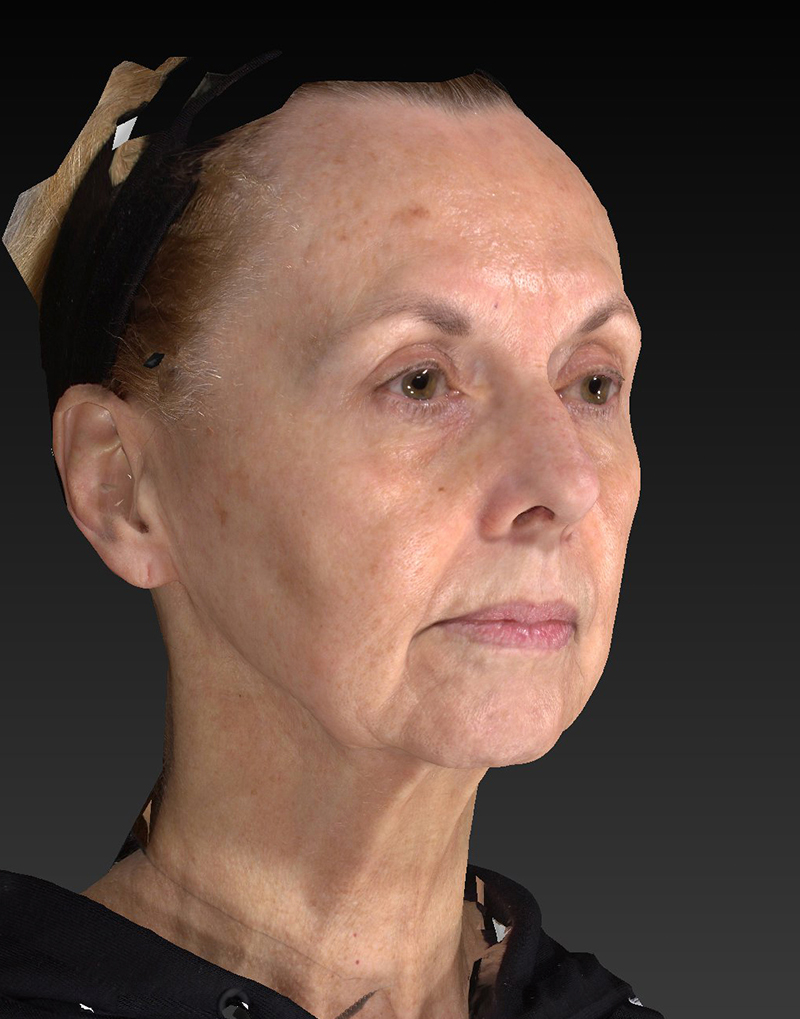 Facelift: Lower Face And Neck Lift Before and After 30