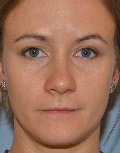 Ptosis Treatment Before and After 02