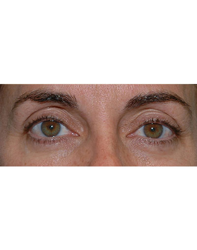 Ptosis Treatment Before and After 02
