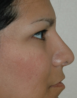 Rhinoplasty Before and After 02